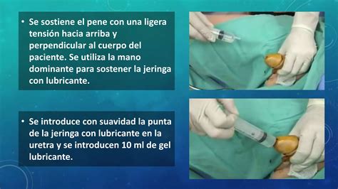 sonda vesical mujer real|Procedimiento de sondaje vesical. Mujeres